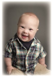 Baby with Downs Syndrome.