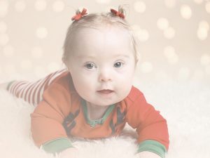 Infant with Down Syndrome.